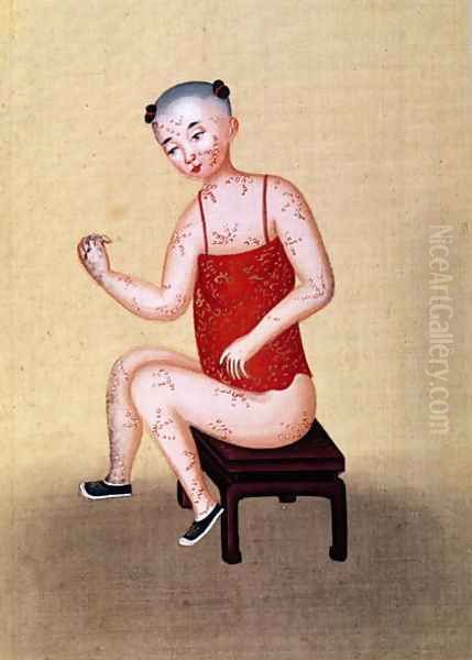 Child with smallpox (2) Oil Painting by Anonymous Artist