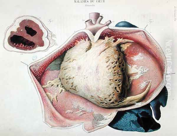 Pericarditis, plate depicting heart diseases from 'Anatomie pathologique du corps humain' Oil Painting by Antoine Chazal