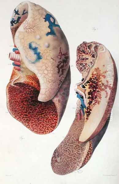 Pneumonia, from 'Anatomie Pathologique du Corps Humain' Oil Painting by Antoine Chazal