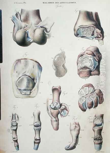 Diseases of the joints, from 'Anatomie Pathologique du Corps Humain' Oil Painting by Antoine Chazal