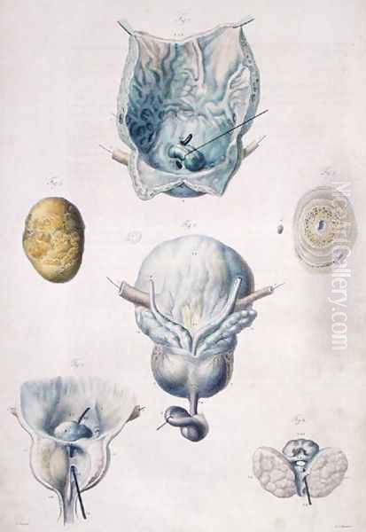 Diseases of the bladder and prostate, from 'Anatomie Pathologique du Corps Humain' Oil Painting by Antoine Chazal