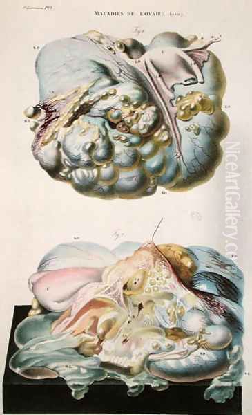 Diseases of the Ovaries, from 'Anatomie Pathologique du Corps Humain' Oil Painting by Antoine Chazal