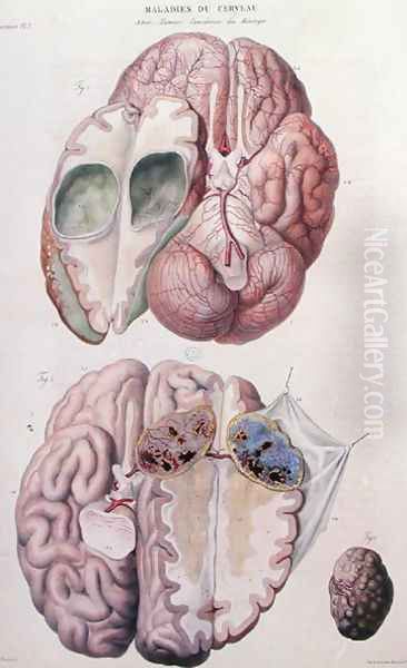 Cancerous tumours of the brain, from 'Anatomie Pathologique du Corps Humain' Oil Painting by Antoine Chazal