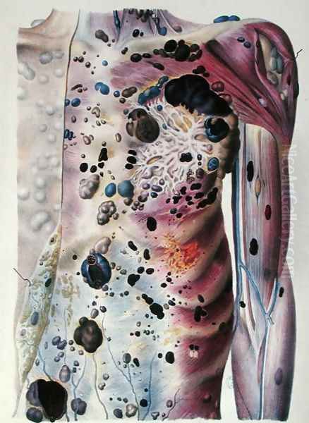 Tumours and cancerous tubercles, from 'Anatomie Pathologique du Corps Humain', 1828-42 Oil Painting by Antoine Chazal