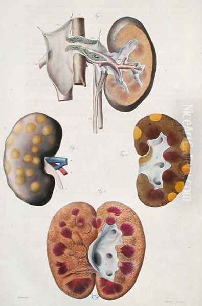 Diseases of the kidneys, from 'Anatomie Pathologique du Corps Humain' Oil Painting by Antoine Chazal