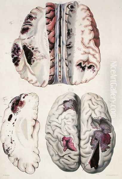 Capillary apoplexy, from 'Anatomie Pathologique du Corps Humain', 1828-42 Oil Painting by Antoine Chazal