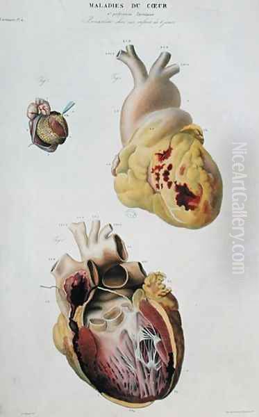 Plate depicting heart diseases. Spontaneous rupture of the heart of an 86 year old woman (fig. 1) and pericarditis in a six day old baby (fig. 2), from 'Anatomie pathologique du corps humain', 1828-42 Oil Painting by Antoine Chazal