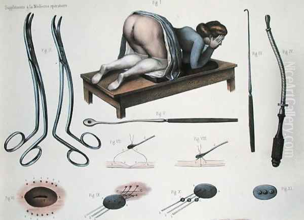 An operation on a vesicovaginal fistula Oil Painting by Nicolas Henri Jacob