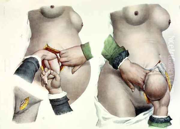 Birth by Caesarean Oil Painting by Nicolas Henri Jacob