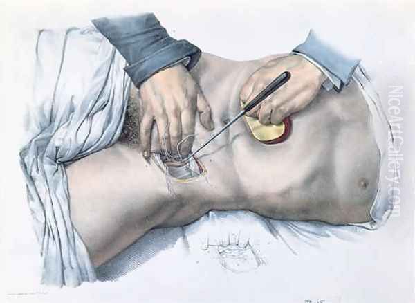 Tying up an artery Oil Painting by Nicolas Henri Jacob