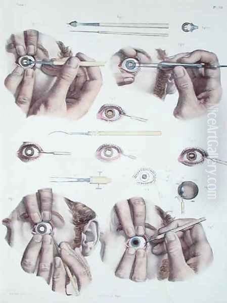 Operation on a eye Oil Painting by Nicolas Henri Jacob