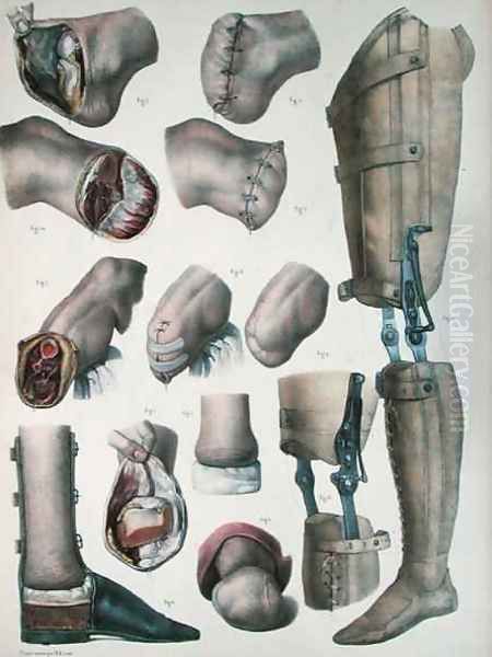 Amputations and Prosthetics Oil Painting by Nicolas Henri Jacob