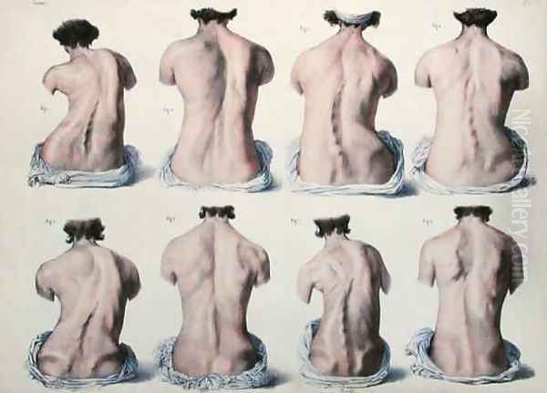 Spinal Deformities Oil Painting by Nicolas Henri Jacob