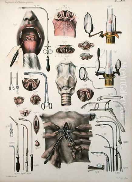 Tracheotomy operation, plate from Traite Complet de lAnatomie de lHomme by Jean-Baptiste Marc Bourgery 1797-1849 1866-67 Oil Painting by E. Pochet