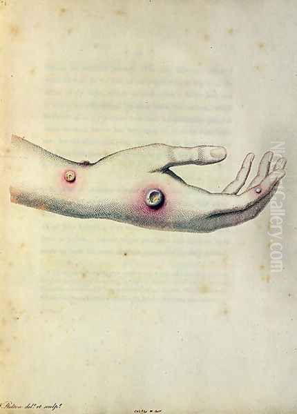 Cowpox pustule on the arm of Sarah Nelmes, from An Inquiry into the Causes and Effects of the Variolae Vaccinae by Edward Jenner 1749-1823 engraved by Pearce, c.1800 Oil Painting by William Skelton