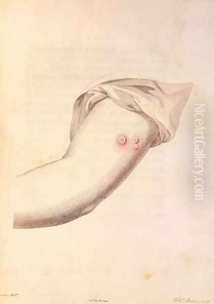 Arm of William Pead used for smallpox vaccine, from An Inquiry into the Causes and Effects of the Variolae Vaccinae by Edward Jenner 1748-1823 engraved by Pearce, c.1800 Oil Painting by William Skelton