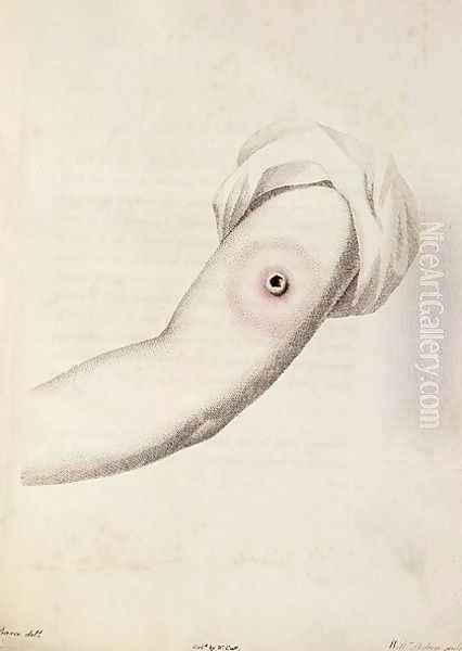 Cowpox pustule on an arm, from An Inquiry into the Causes and Effects of the Variolae Vaccinae by Edward Jenner 1749-1823 engraved by Pearce, c.1800 Oil Painting by William Skelton