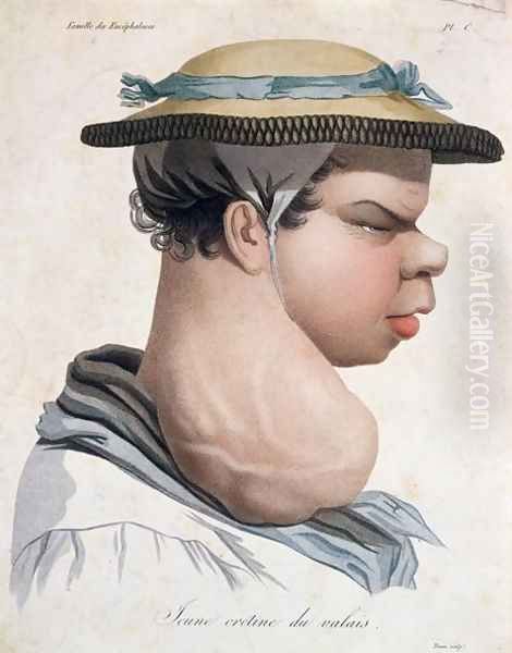 Young Cretin from Valais, illustration from a book by Baron Jean Louis Alibert 1768-1837 Oil Painting by Salvadore Tresca