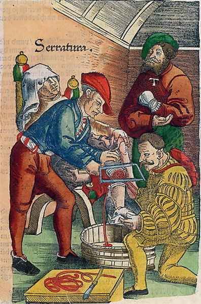 An Amputation, illustration from Feldtbuch der Wundartzney by Hans von Gersdorff, c.1540 Oil Painting by Hans or Johannes Ulrich Wechtlin