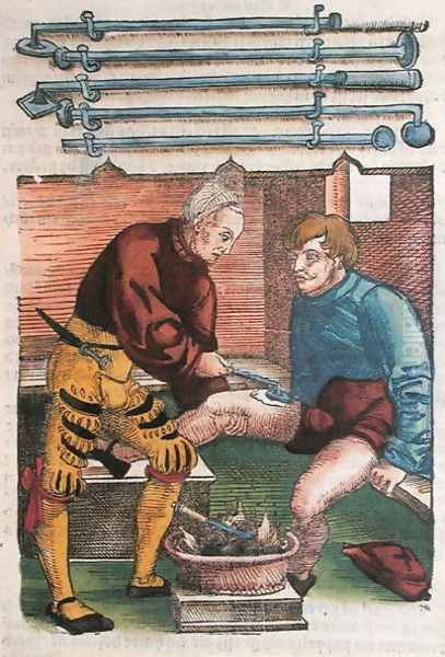 Cauterisation, illustration from Feldtbuch der Wundartzney by Hans von Gersdorff, c.1540 Oil Painting by Hans or Johannes Ulrich Wechtlin