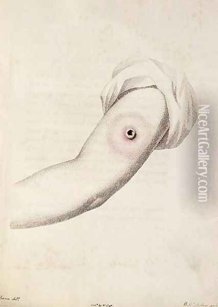 Cowpox pustule on an arm, from An Inquiry into the Causes and Effects of the Variolae Vaccinae by Edward Jenner 1749-1823 engraved by Pearce, c.1800 Oil Painting - William Skelton